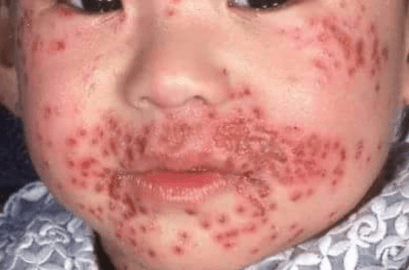 Eczema herpeticum on childs face