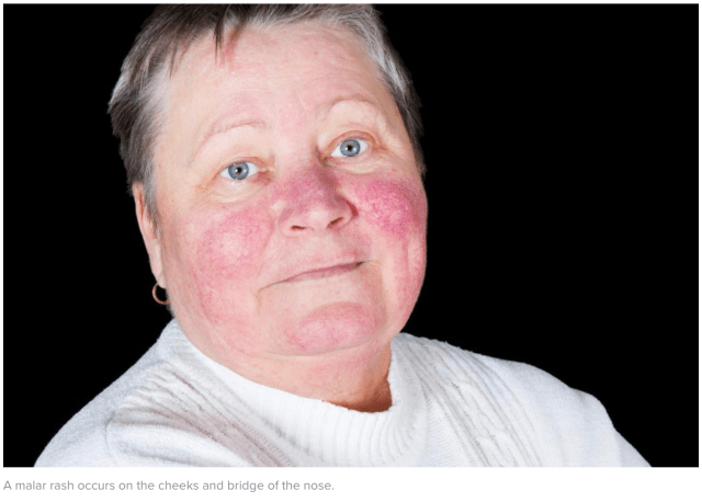 case of malar rash