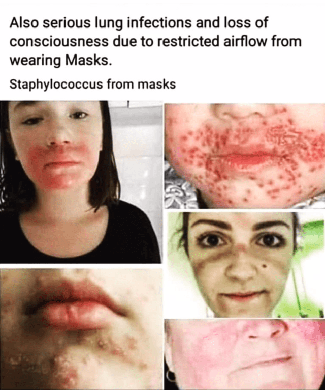image falsely linking skin conditions to mask wearing